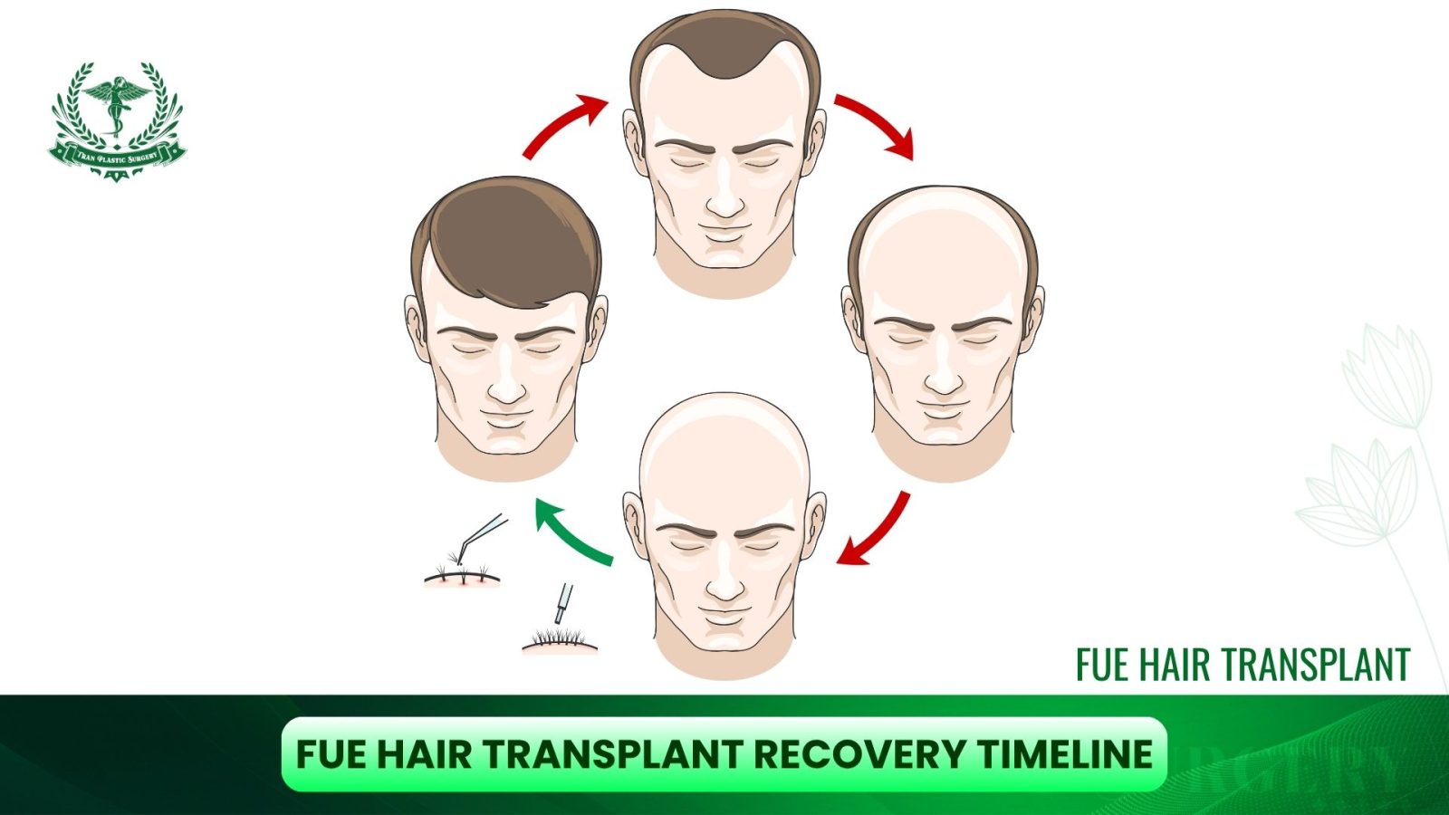 FUE Hair Transplant Recovery Timeline