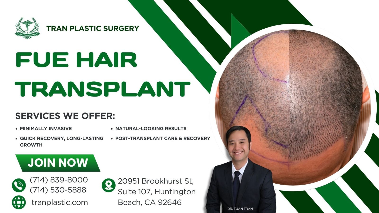 FUE Hair Transplant at Tran Plastic Surgery