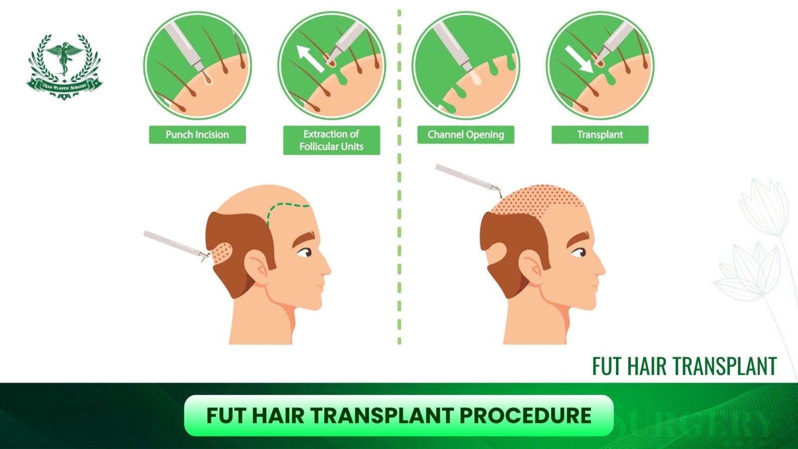 FUT Hair Transplant Procedure