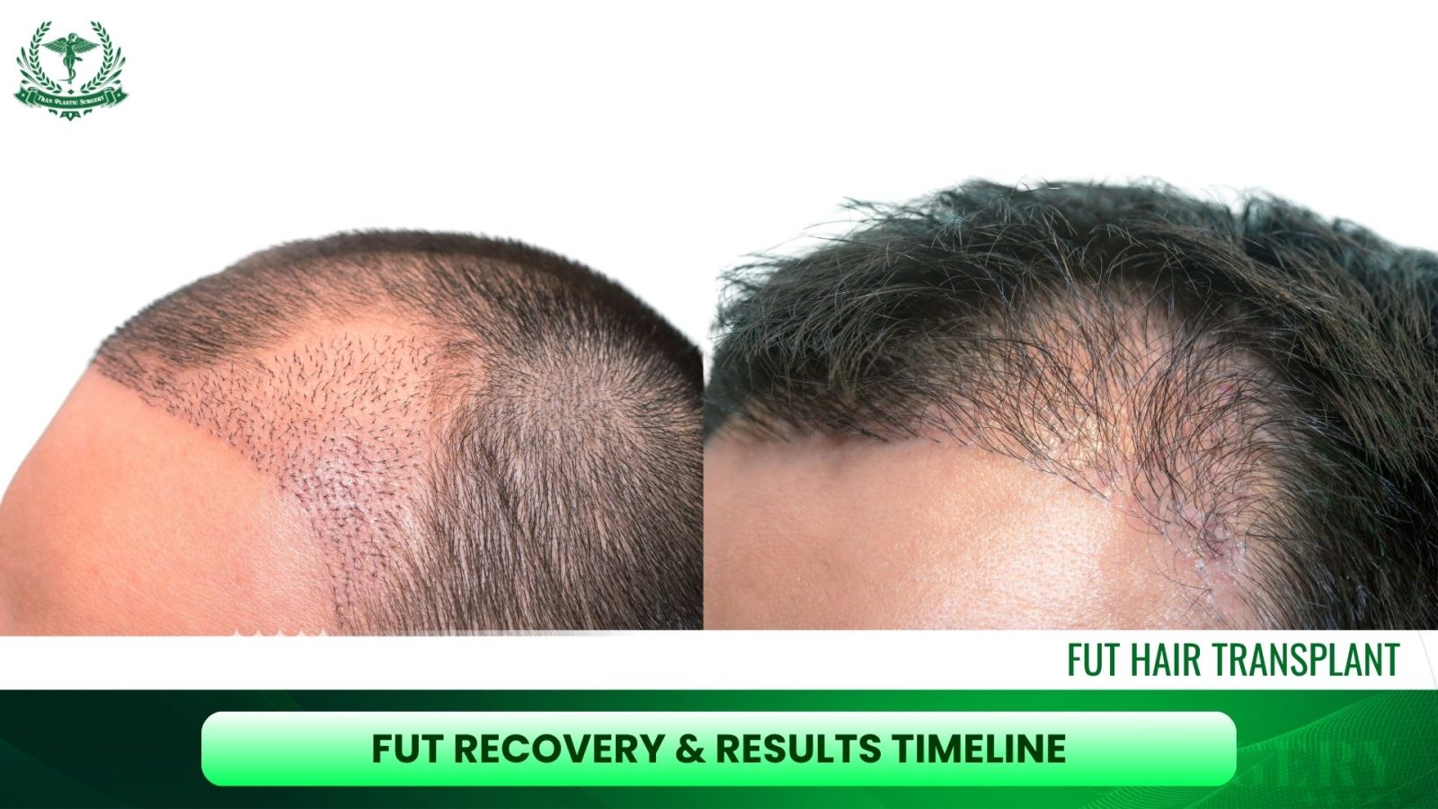 FUT Recovery & Results Timeline