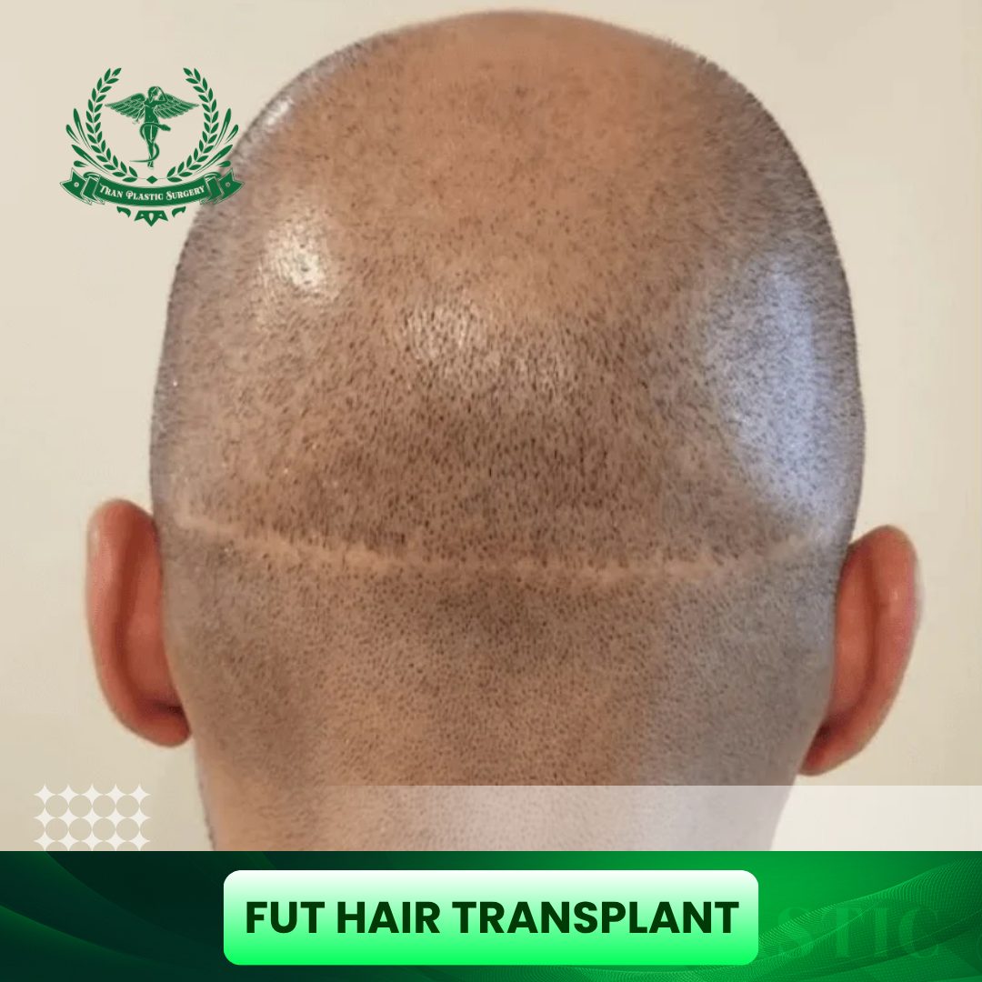 FUT Hair Transplant