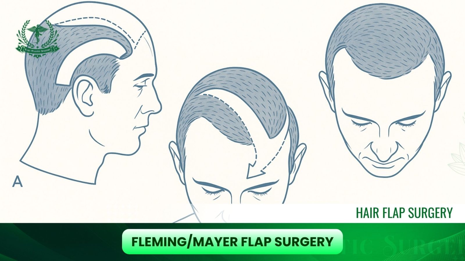 Fleming/Mayer Flap Surgery