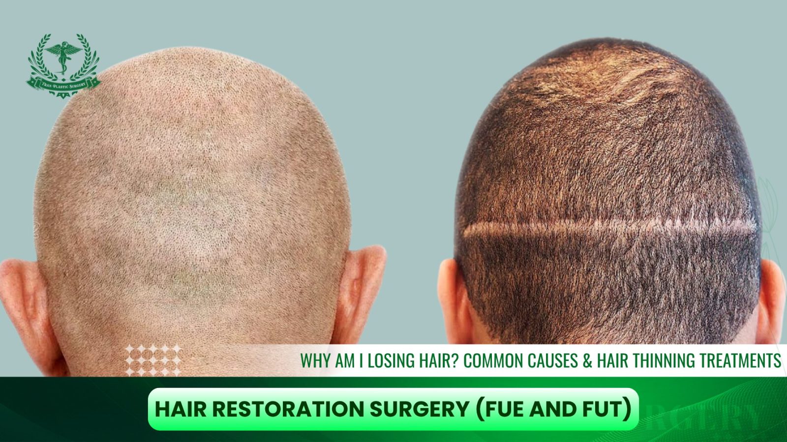 Hair Restoration Surgery (FUE and FUT)