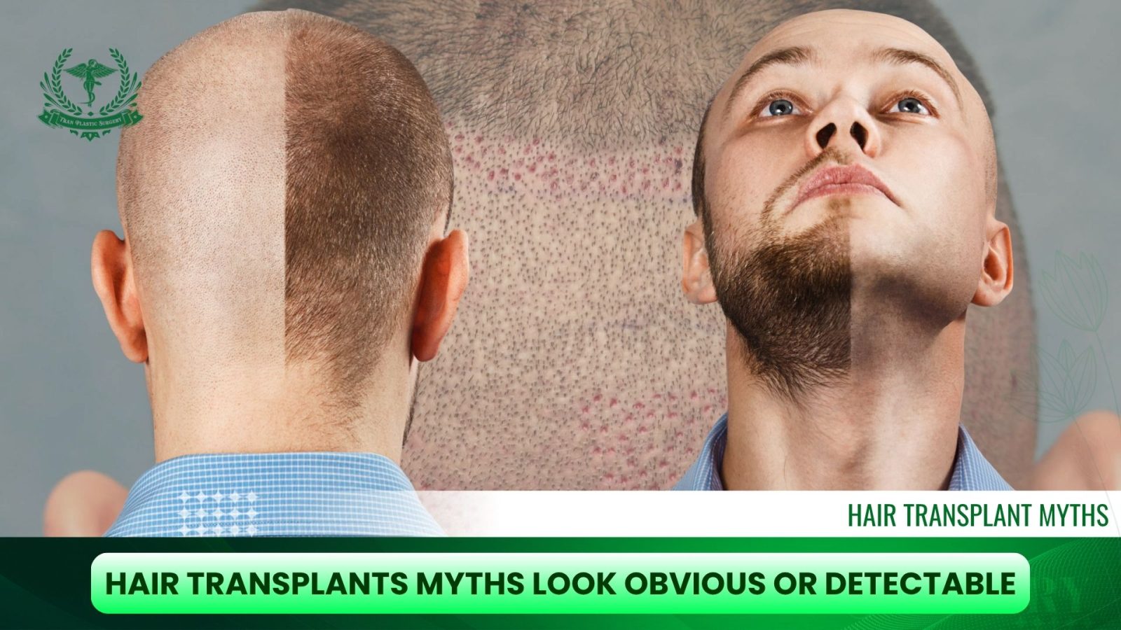 Hair Transplants Myths Look Obvious or Detectable