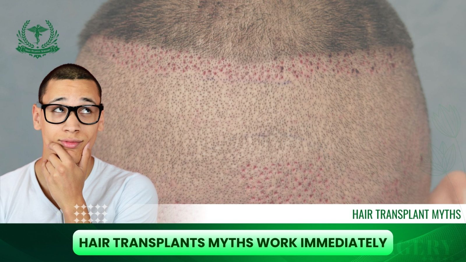 Hair Transplants Myths Work Immediately