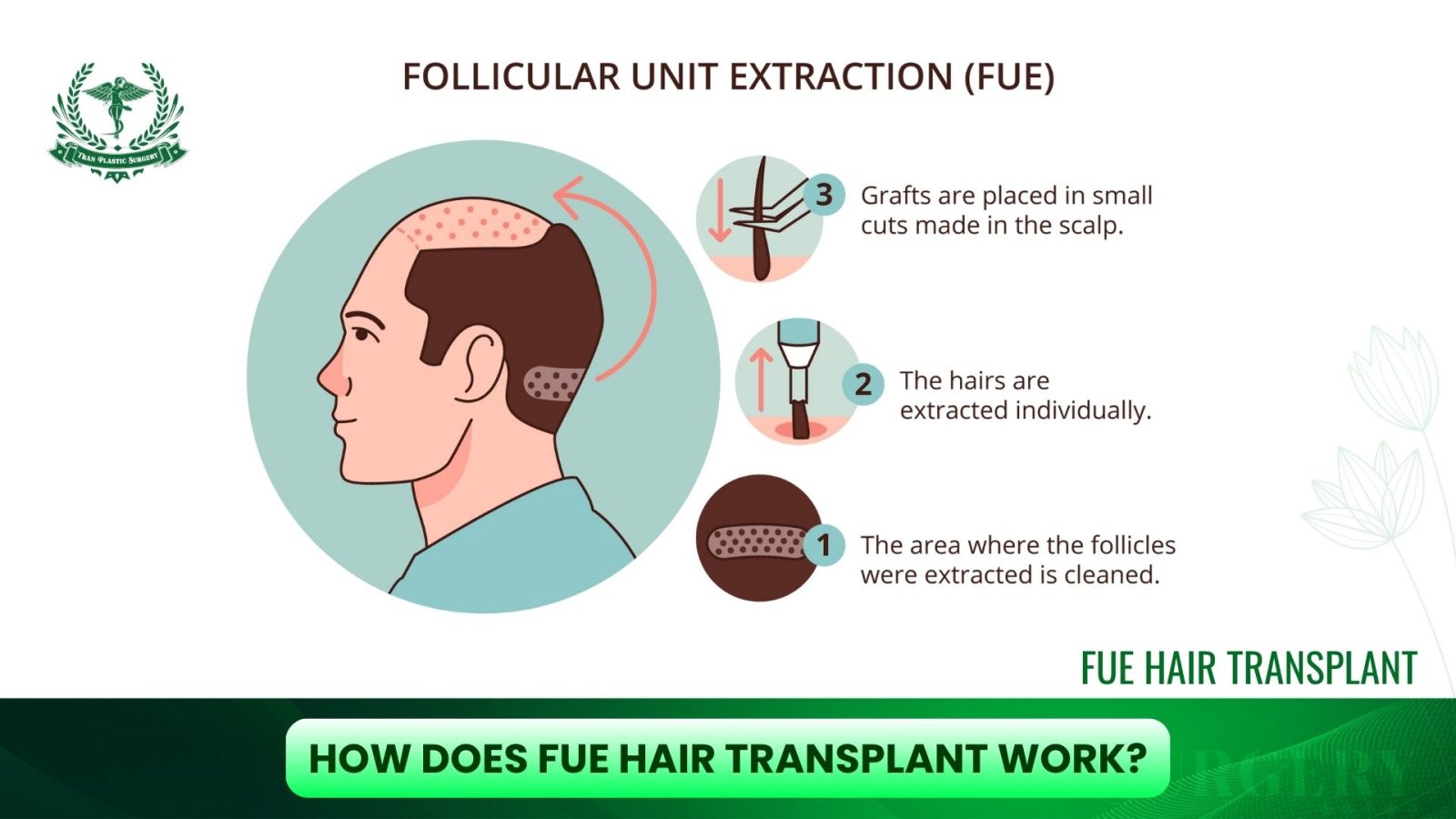 How Does FUE Hair Transplant Work?