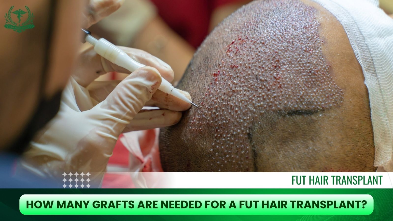 How Many Grafts Are Needed for a FUT Hair Transplant?