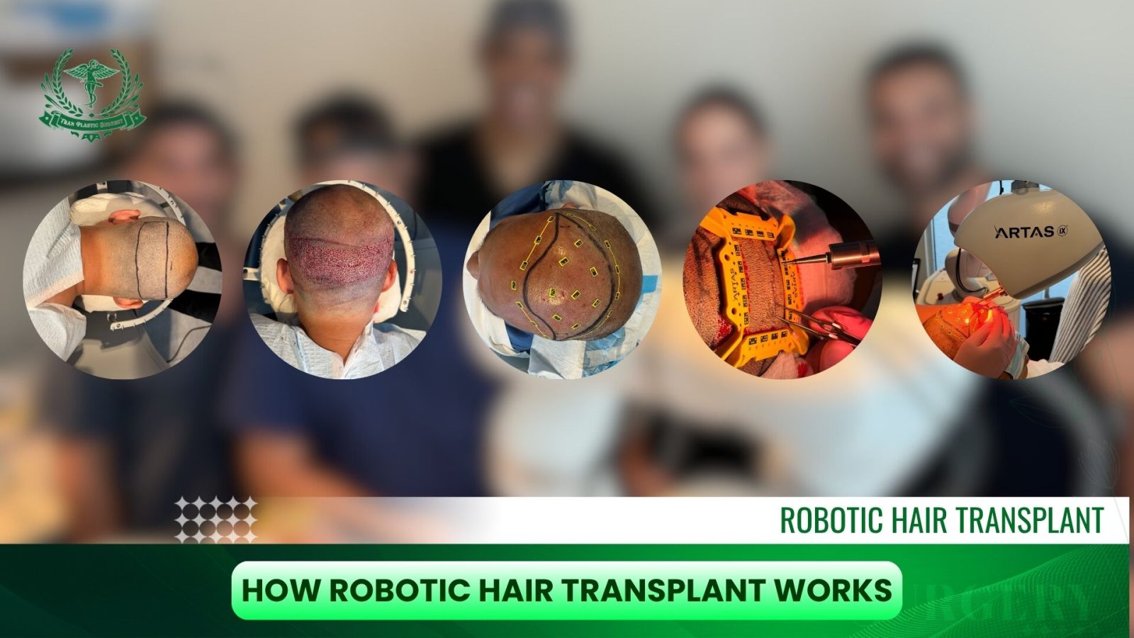 How Robotic Hair Transplant Works