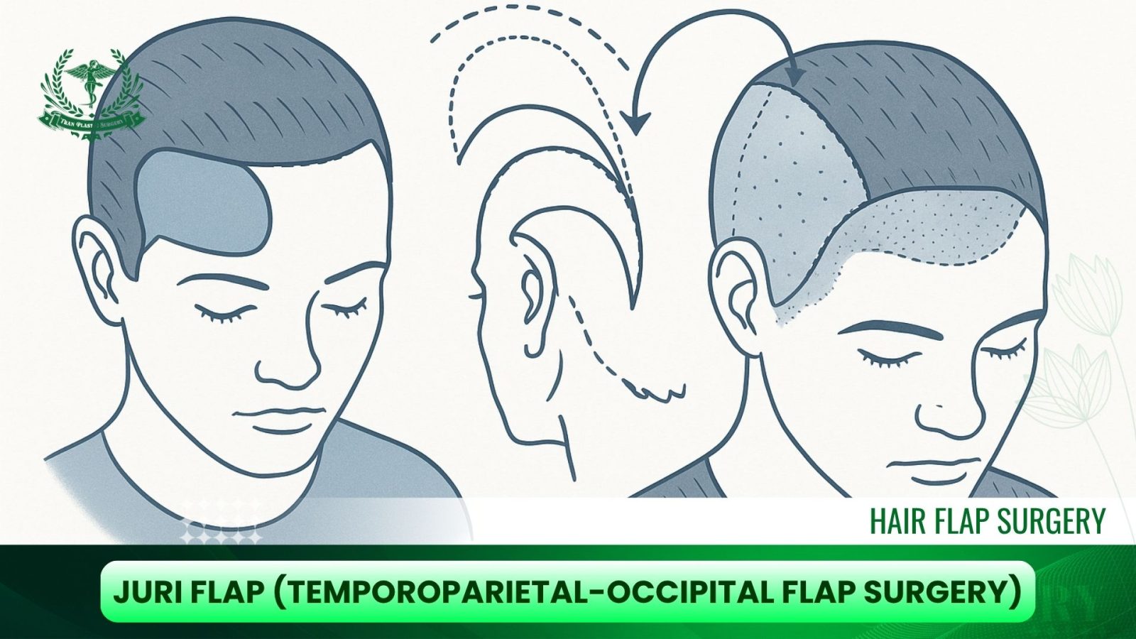Juri Flap (Temporoparietal-Occipital Flap Surgery)