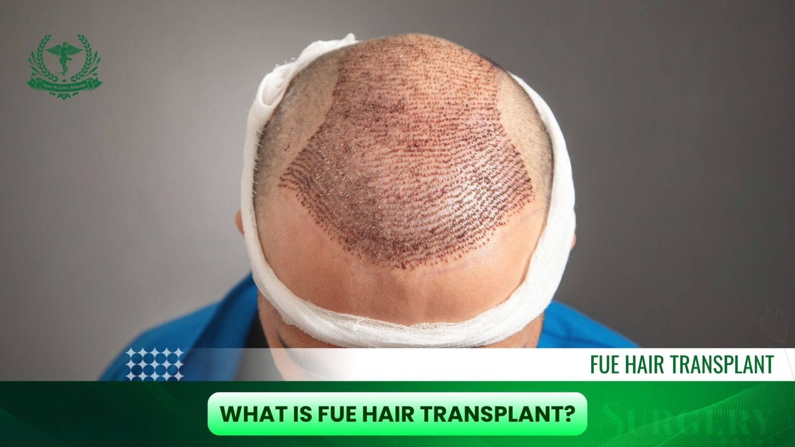 What Is FUE Hair Transplant?