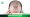 What Is a FUT Hair Transplant?