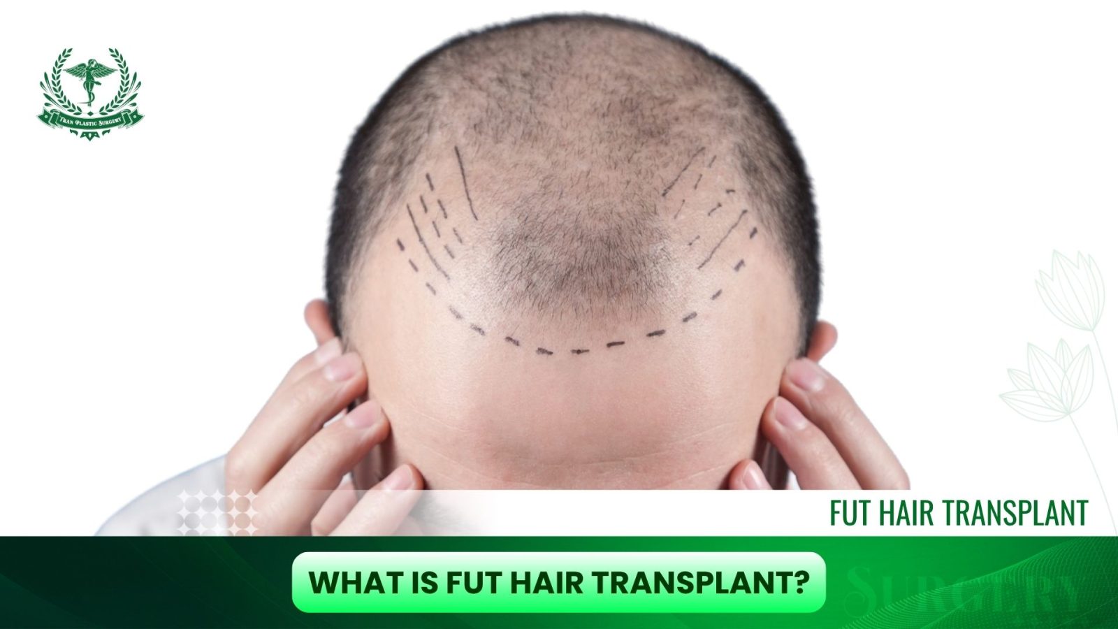 What Is a FUT Hair Transplant?