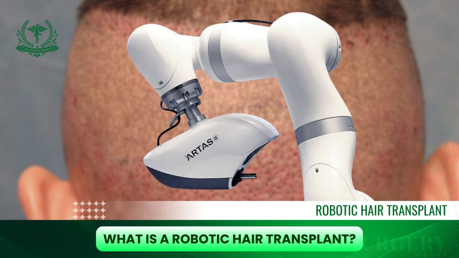 What Is a Robotic Hair Transplant