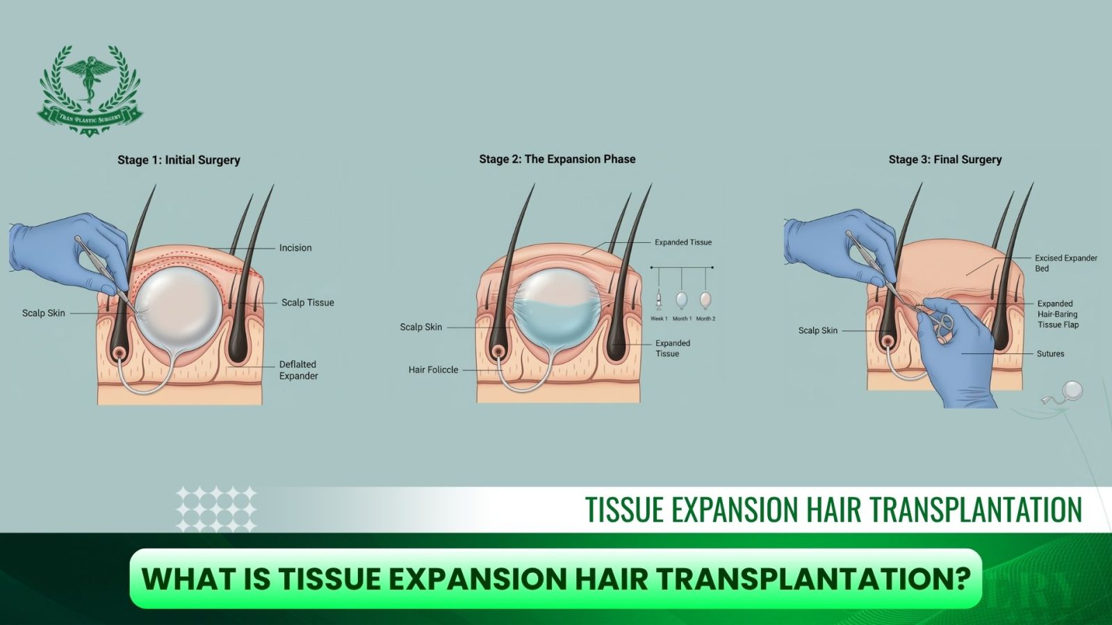 How Tissue Expansion Hair Transplantation Works