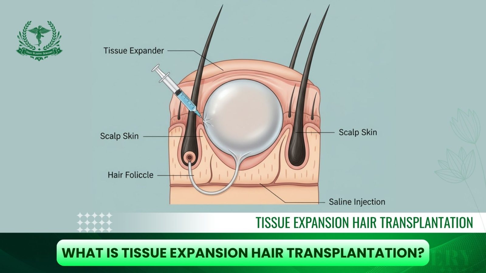 What is Tissue Expansion Hair Transplantation?