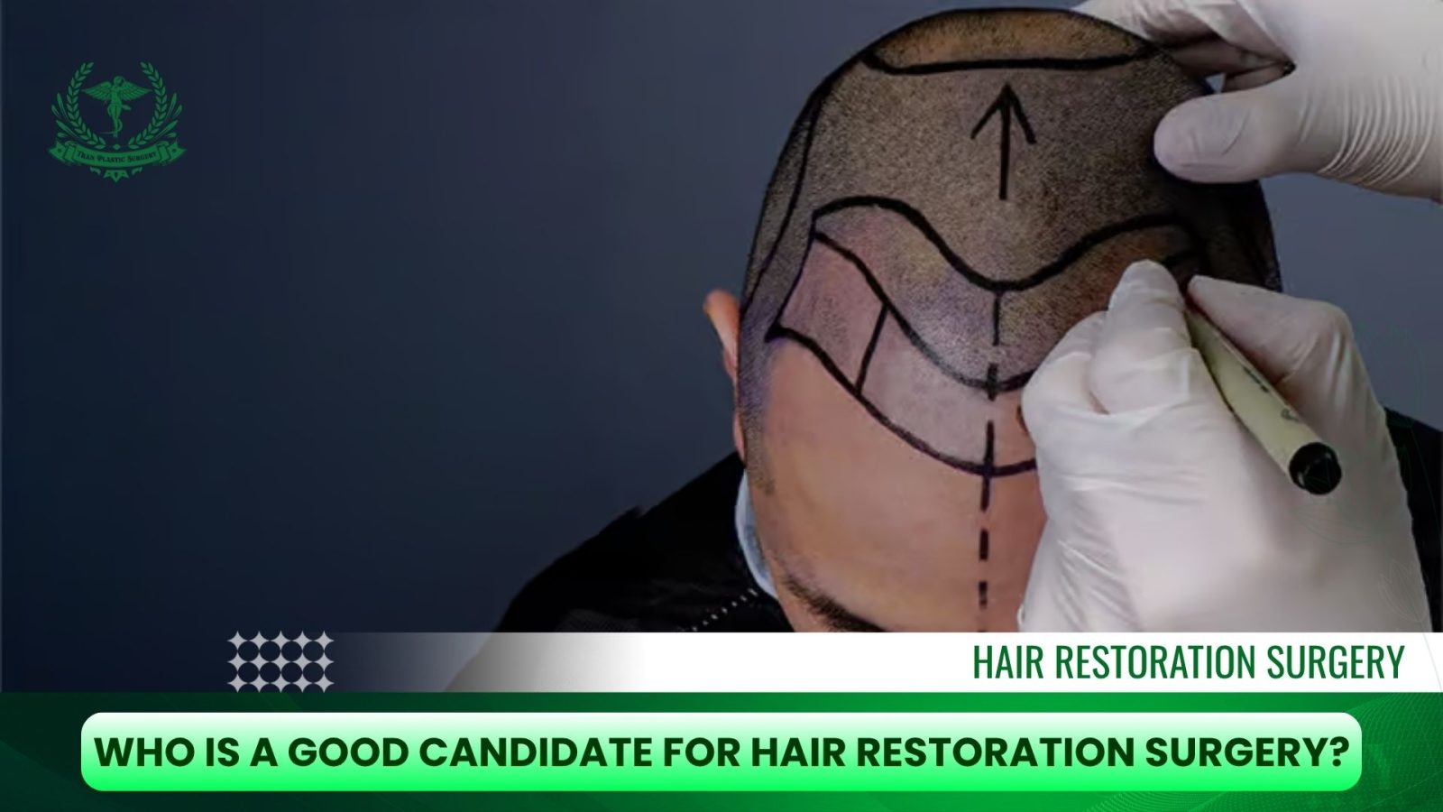 Who Is a Good Candidate for Hair Restoration Surgery?