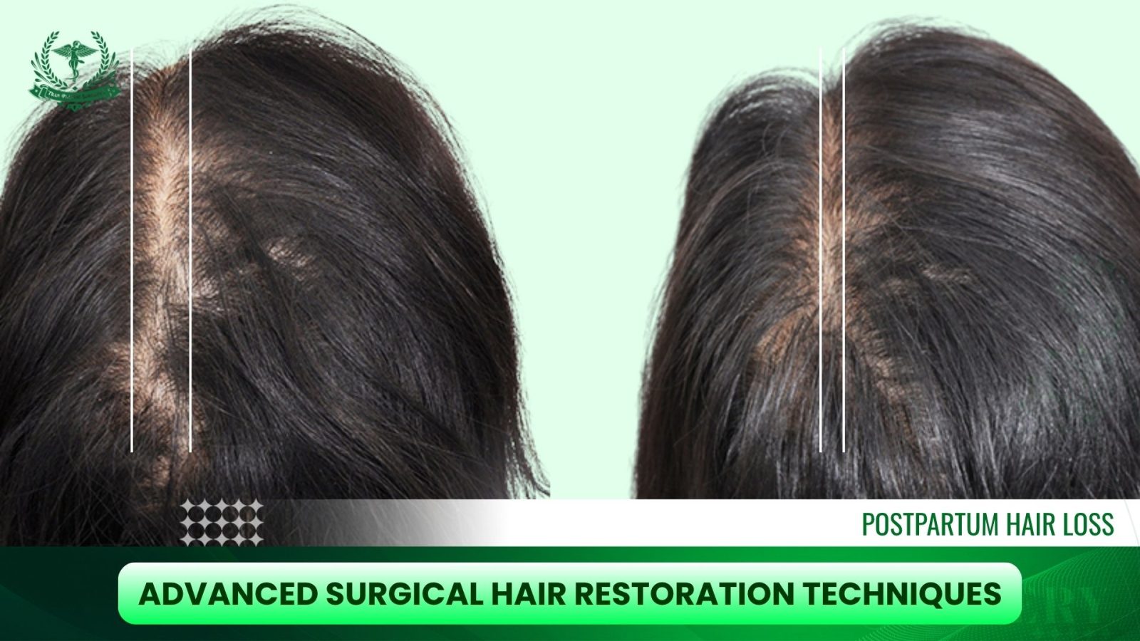 Advanced Surgical Hair Restoration Techniques for Postpartum Women