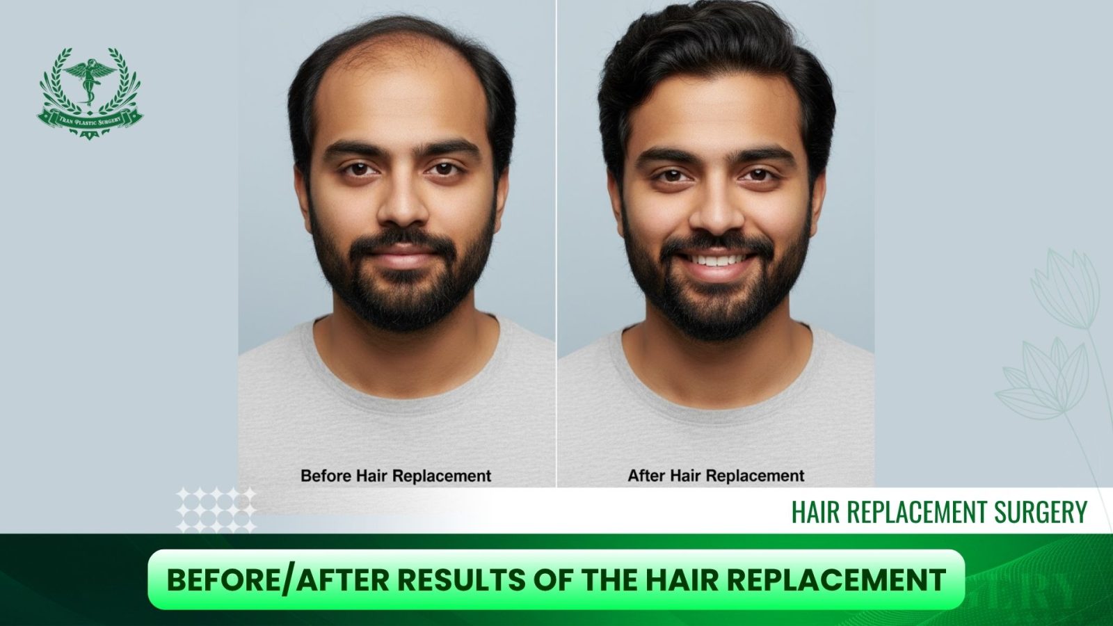 Before_After Results of The Hair Replacement