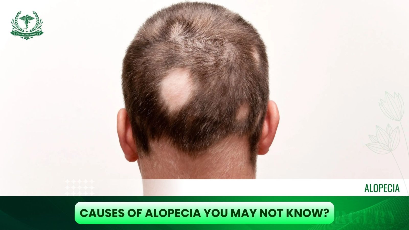 Causes of Alopecia You May Not Know