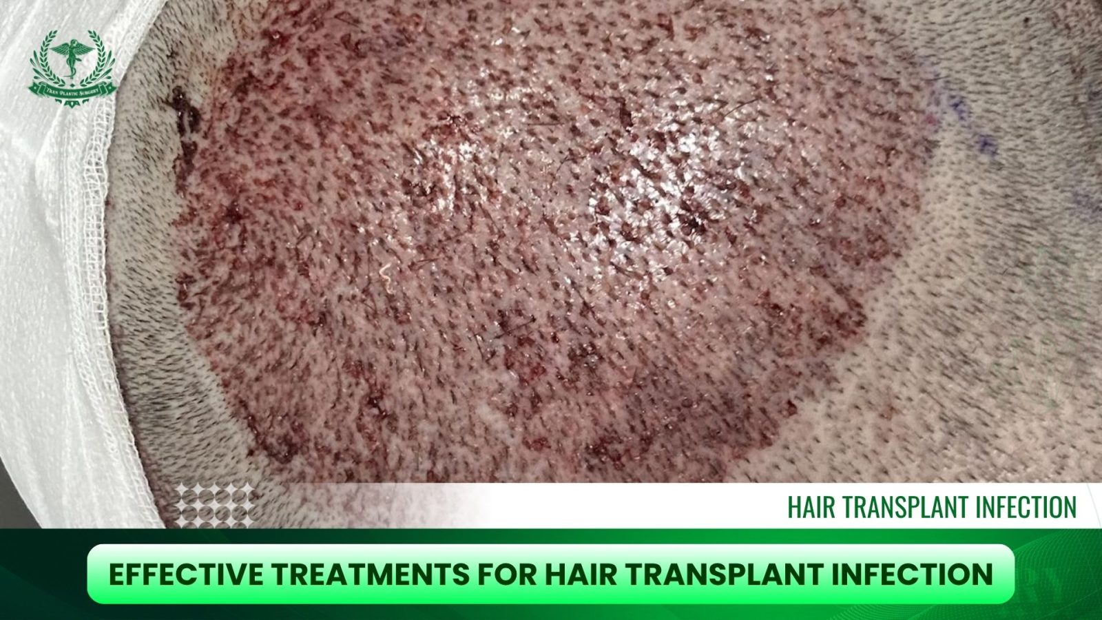Effective Treatments for Hair Transplant Infection