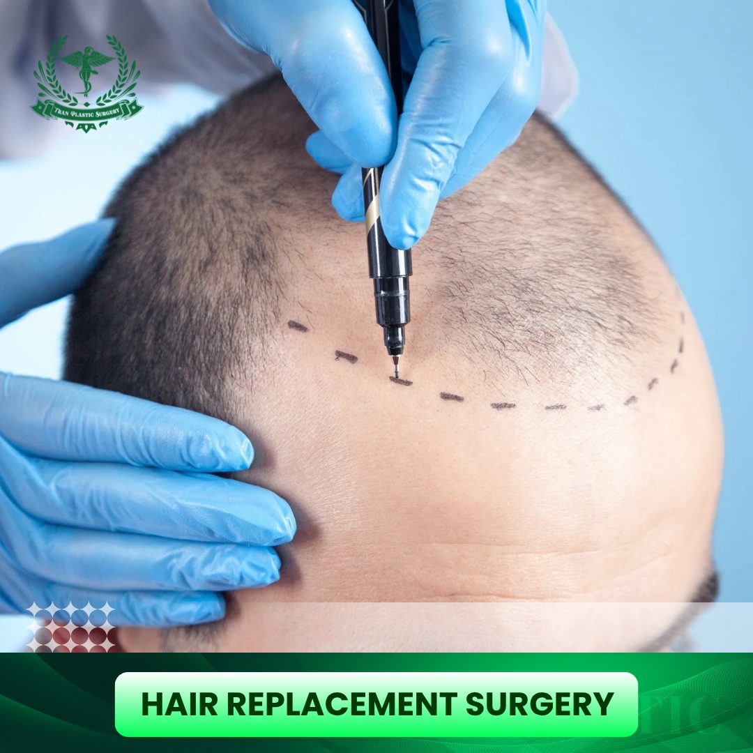 Hair Replacement Surgery