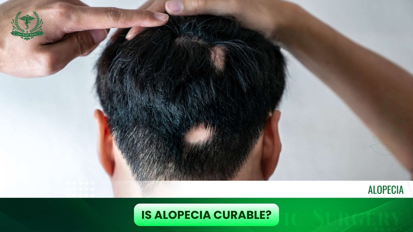 Is Alopecia Curable?