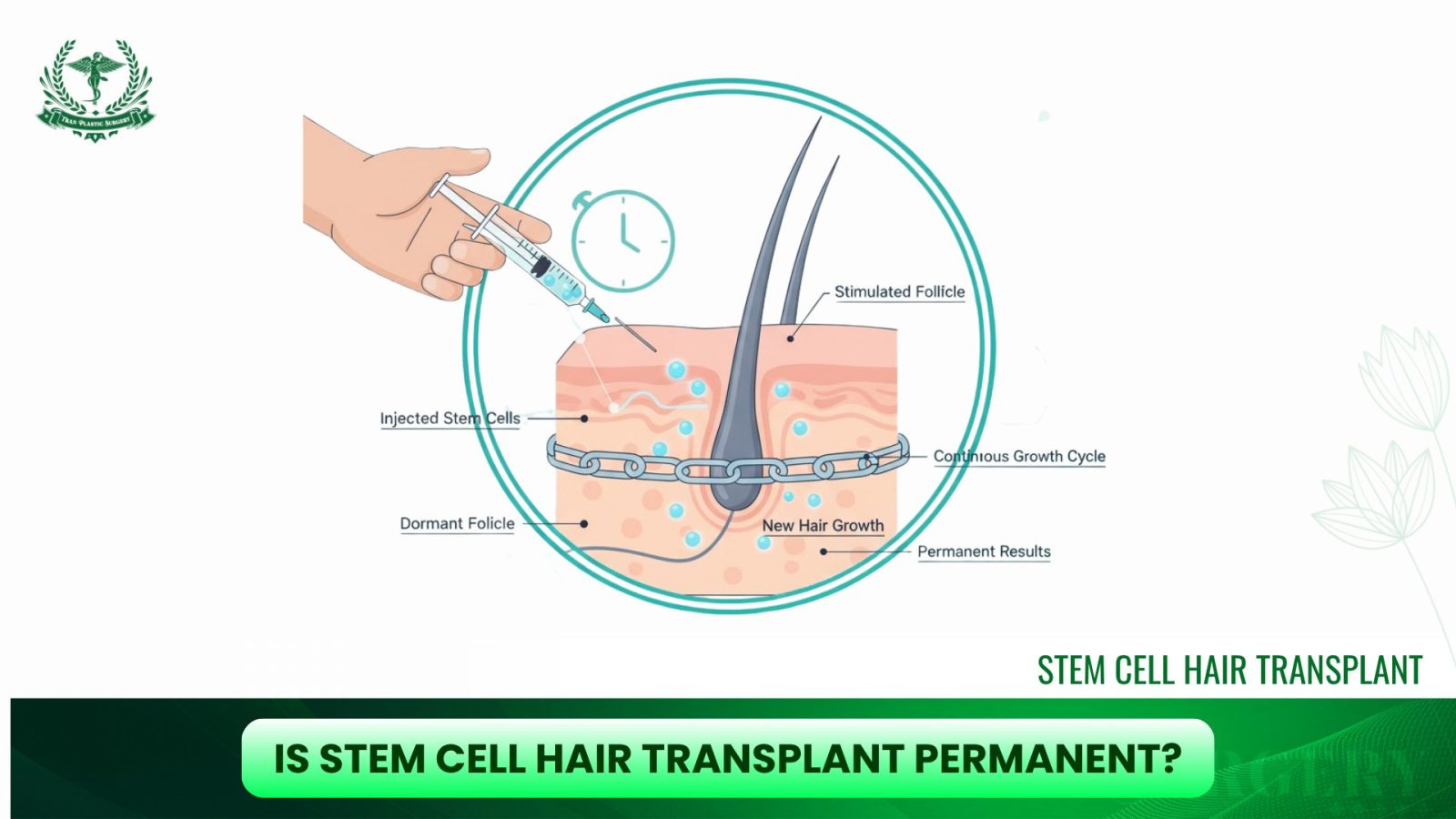 Is Stem Cell Hair Transplant Permanent?