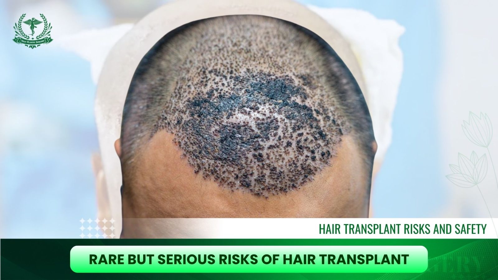 Rare but Serious Risks of Hair Transplant