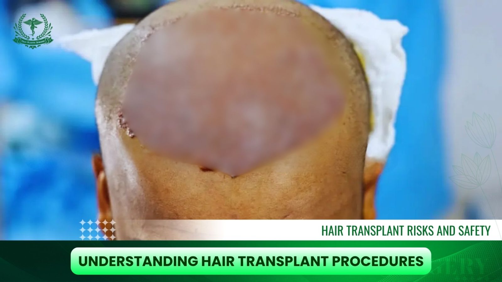 Understanding Hair Transplant Procedures