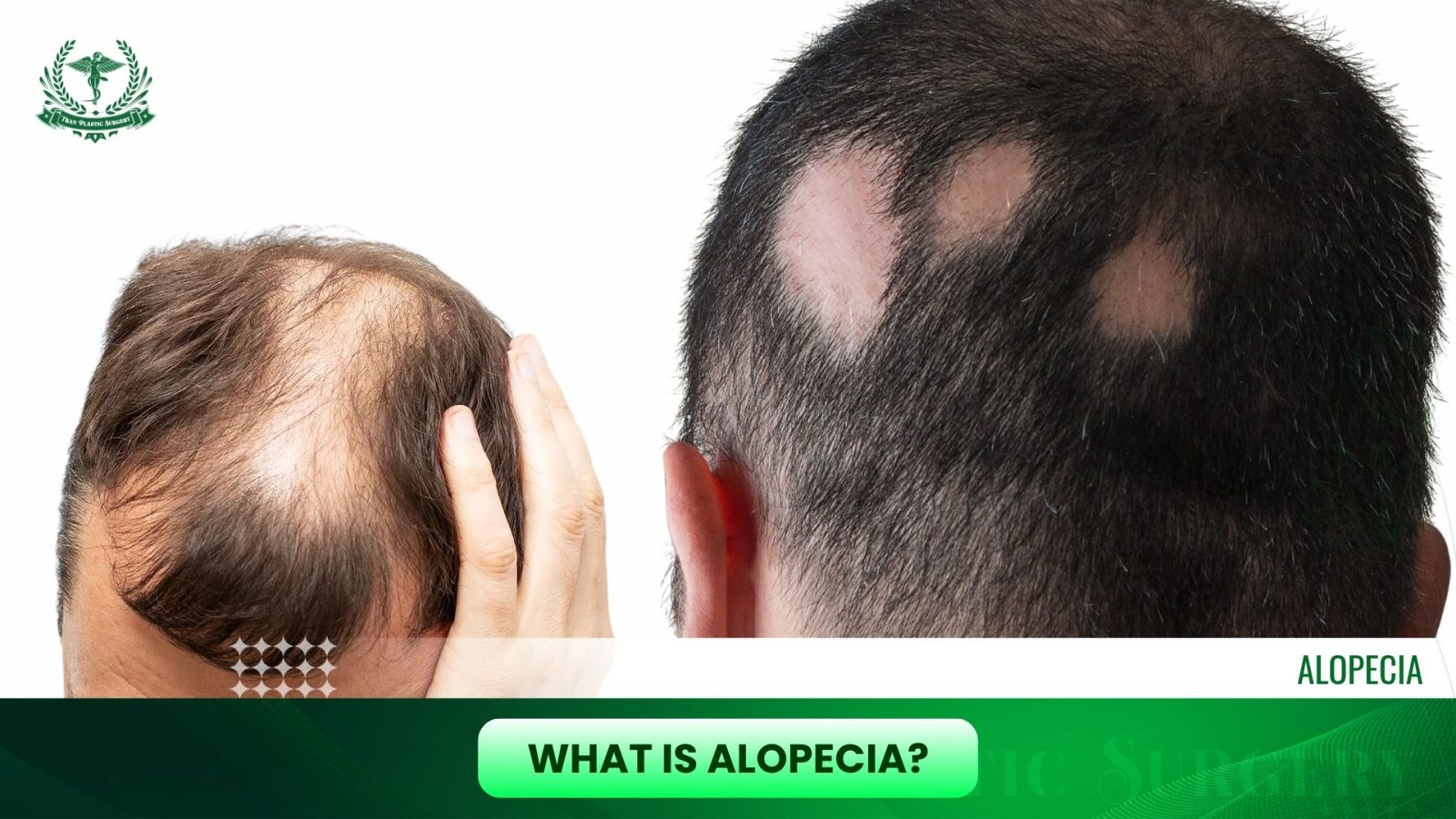 What Is Alopecia?