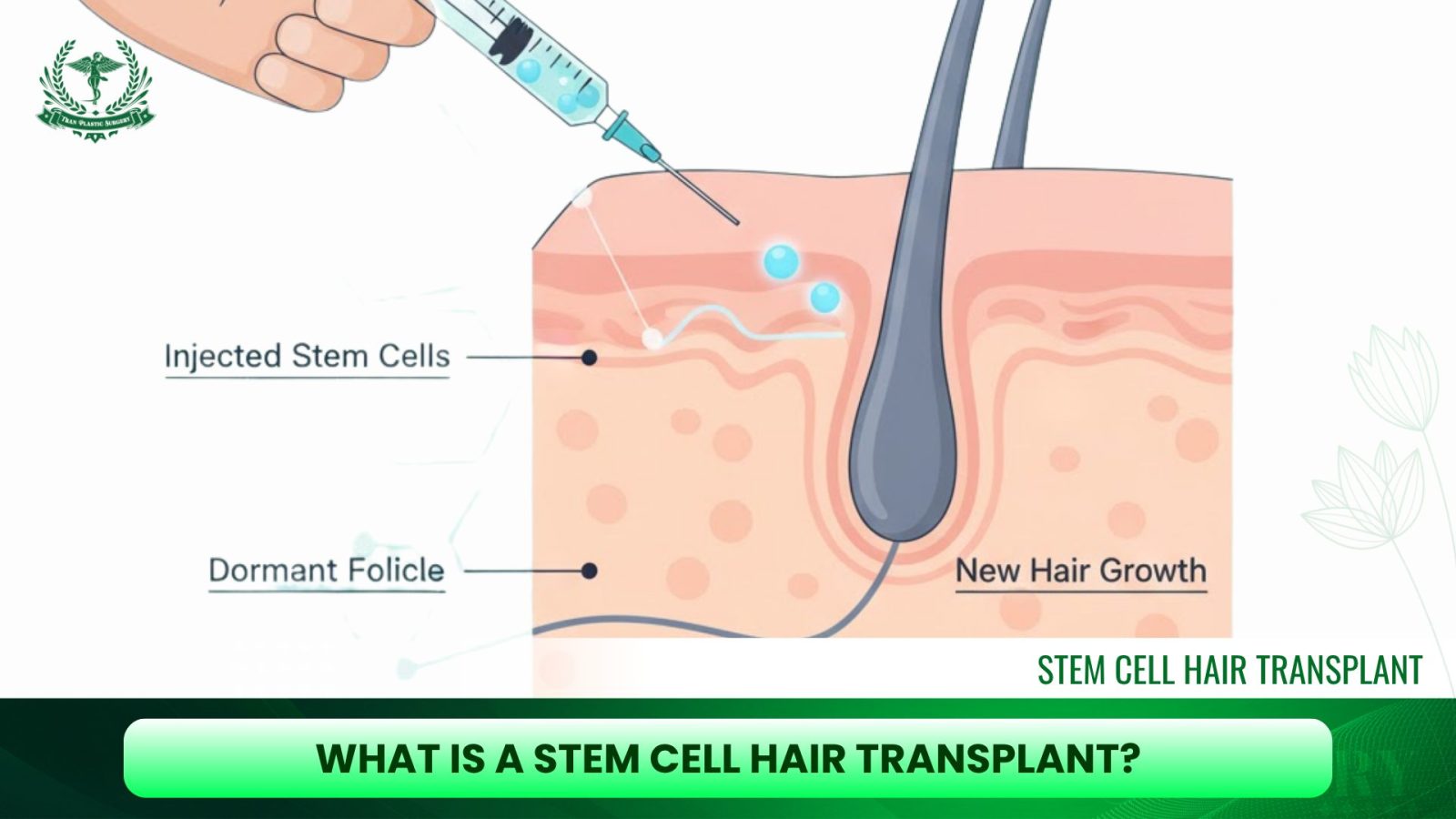 What Is a Stem Cell Hair Transplant