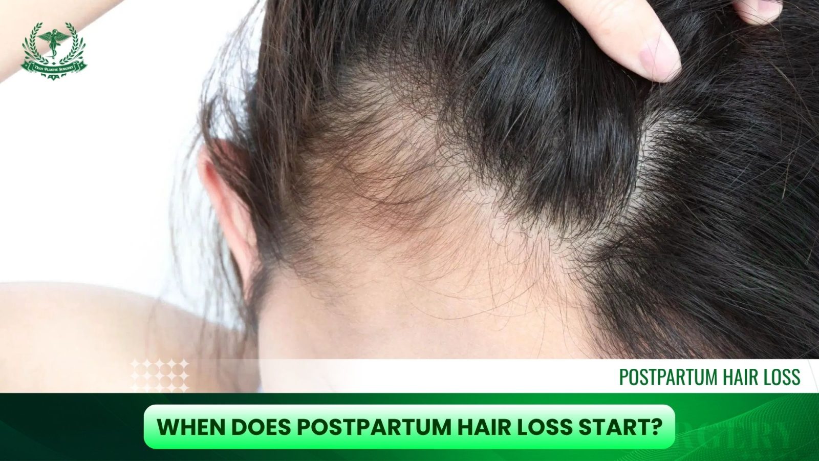 When Does Postpartum Hair Loss Start?