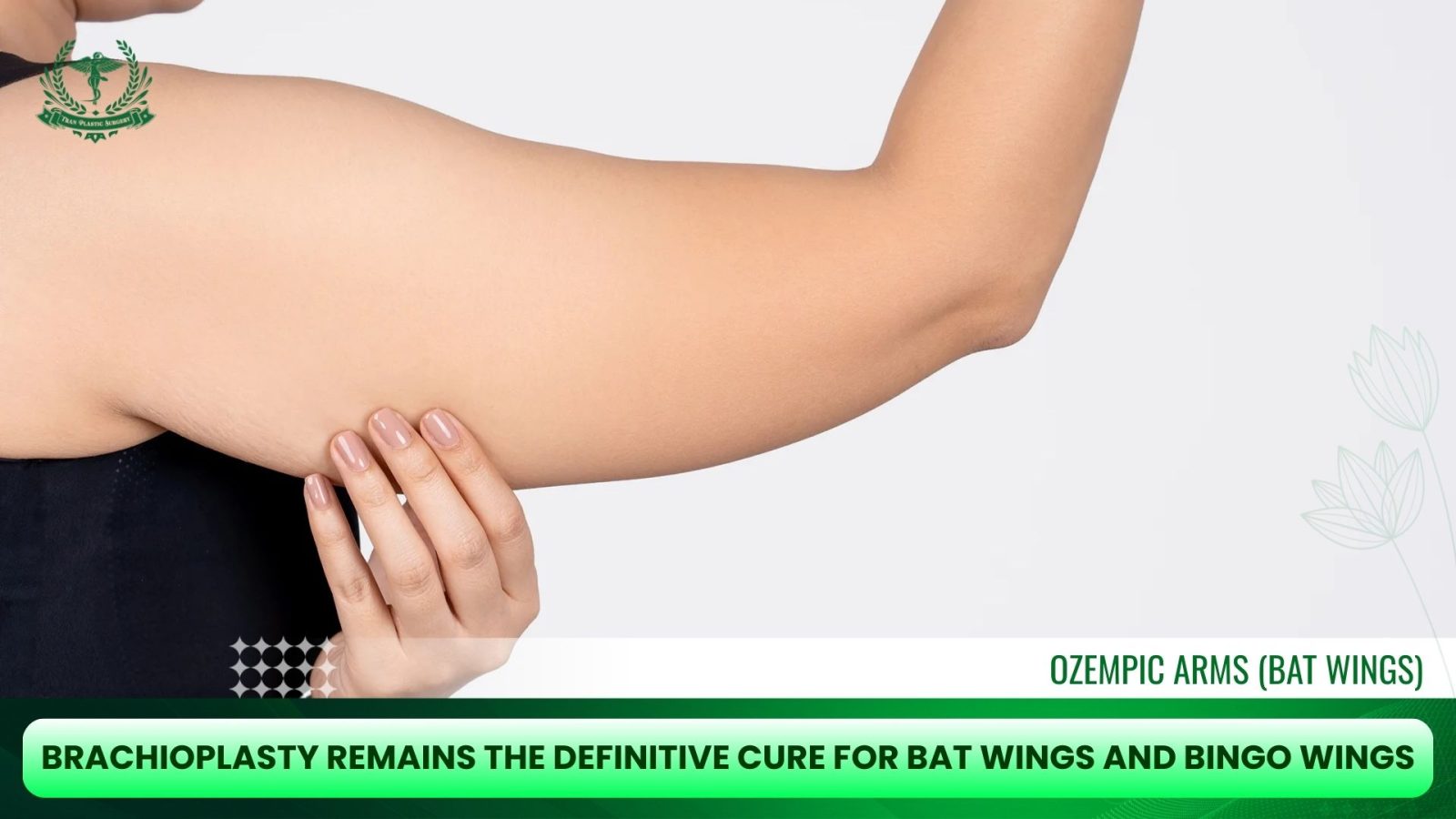 Brachioplasty remains the definitive cure for bat wings, bingo wings, and severe Ozempic arms