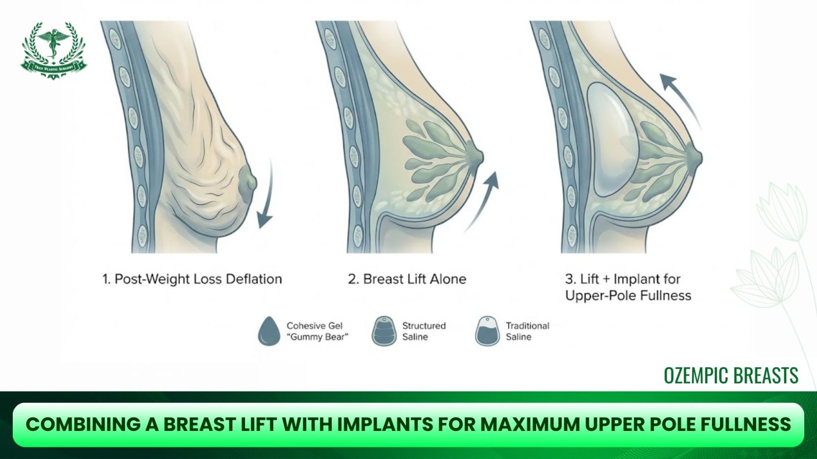 Combining a Breast Lift with Implants for Maximum Upper Pole Fullness