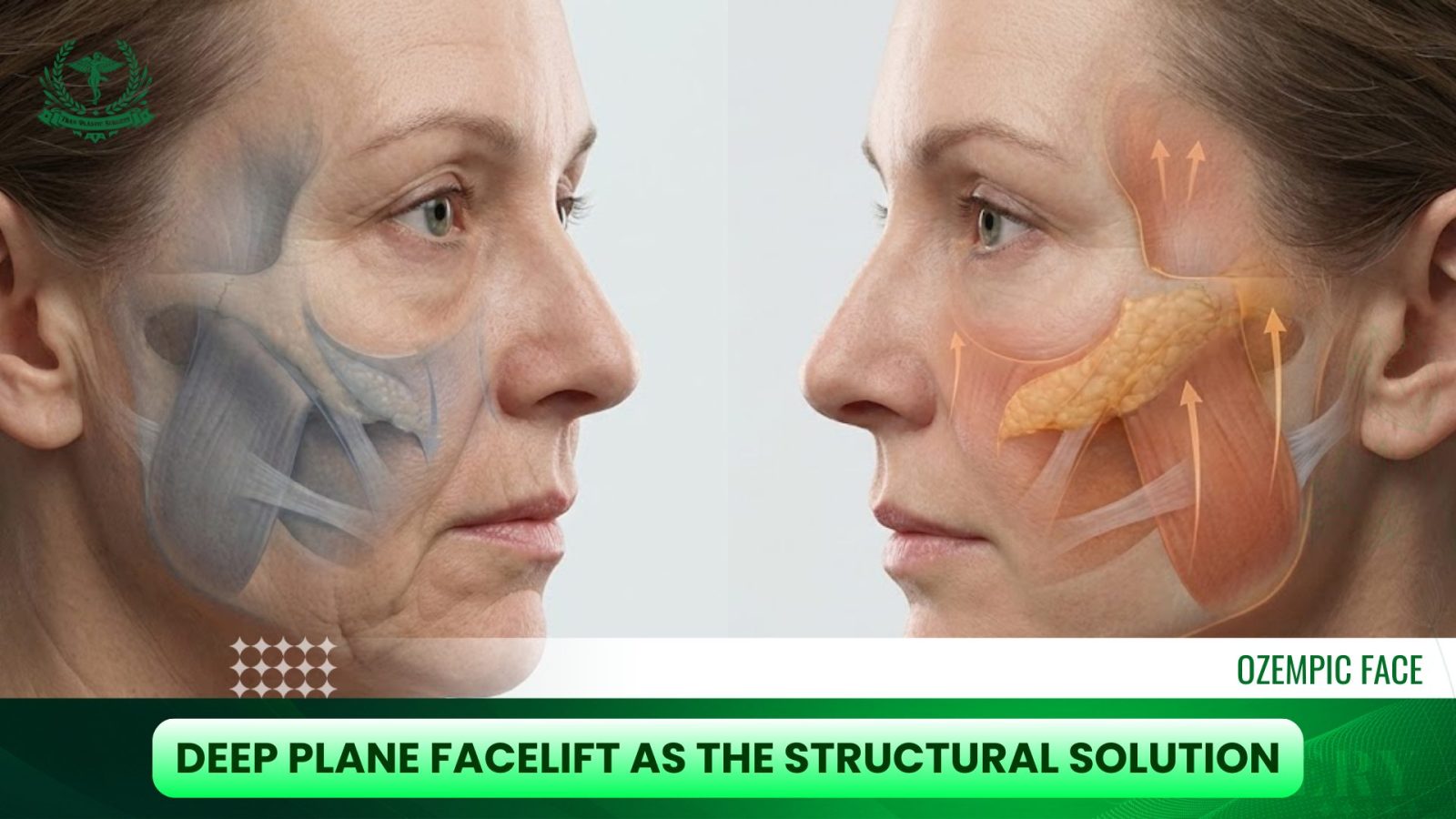 Deep Plane Facelift as the Structural Solution