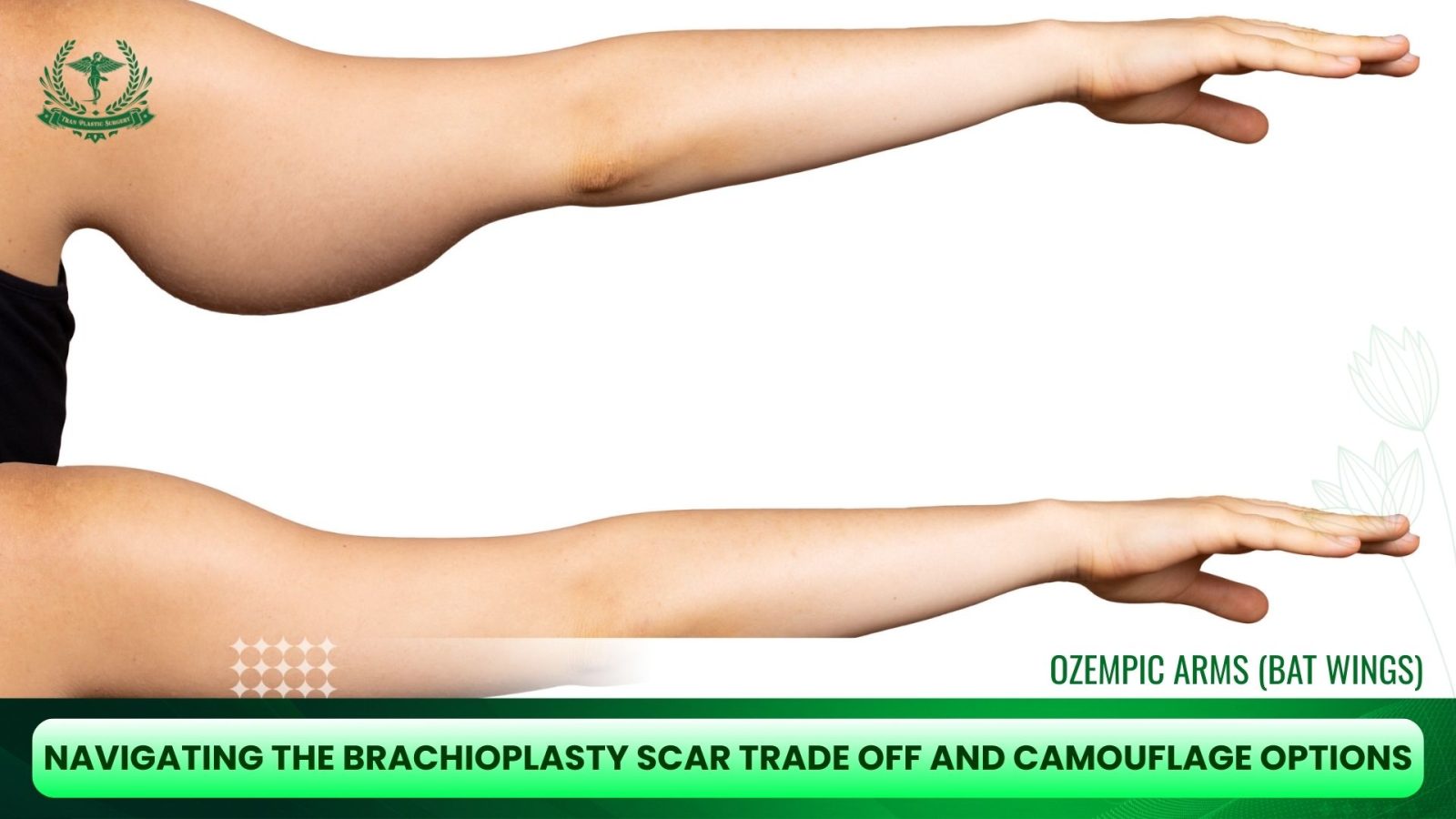 Navigating the Brachioplasty Scar Trade Off and Camouflage Options
