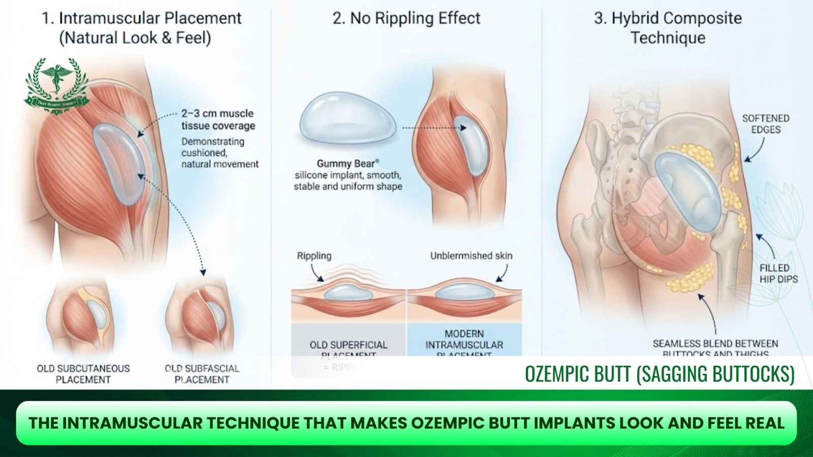 The Intramuscular Technique That Makes Ozempic Butt Implants Look and Feel Real