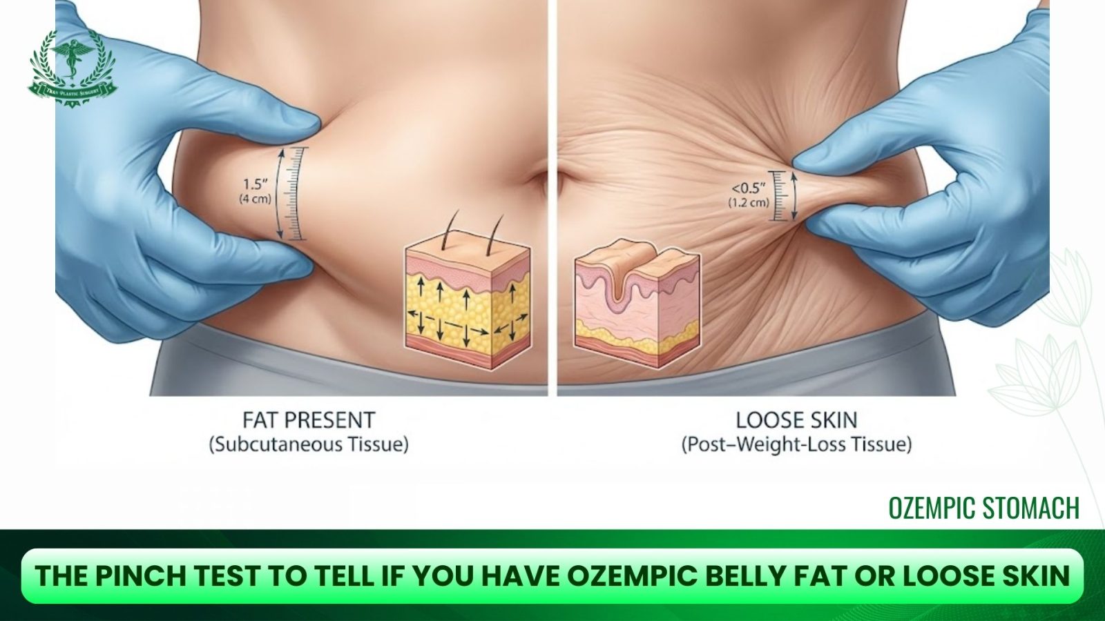 The Pinch Test To Tell If You Have Ozempic Belly Fat or Loose Skin