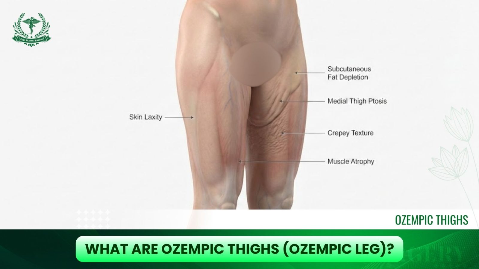 What Are Ozempic Thighs (Ozempic Leg)?