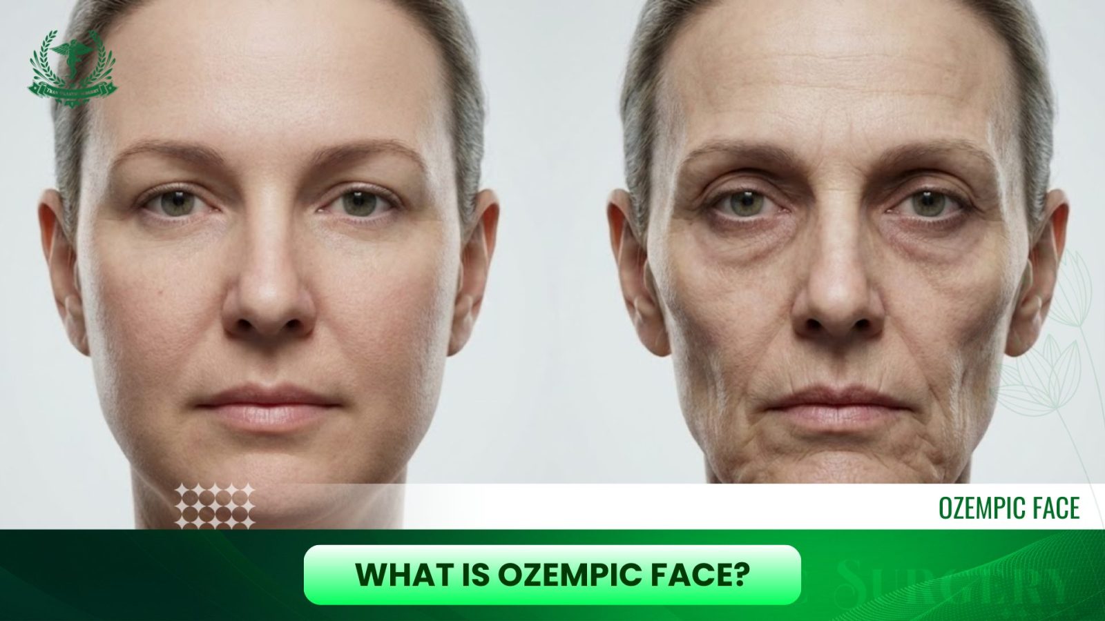 What Is Ozempic Face?