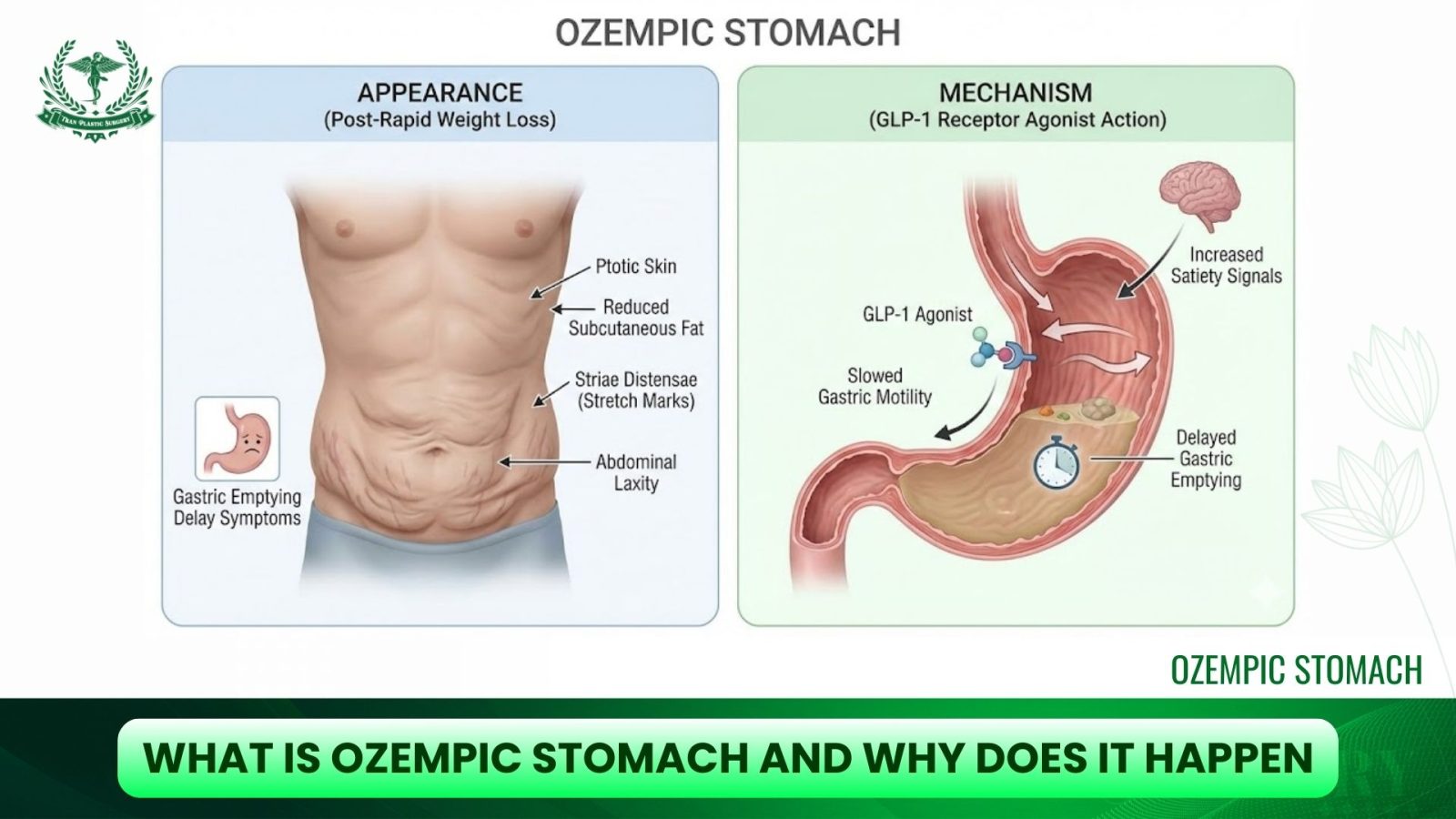 What Is Ozempic Stomach And Why Does It Happen