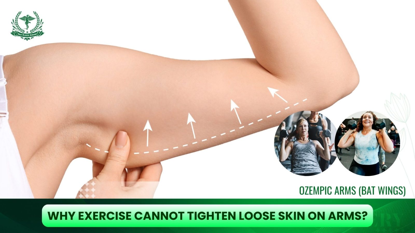 Why exercise cannot tighten loose skin caused by Ozempic arms?