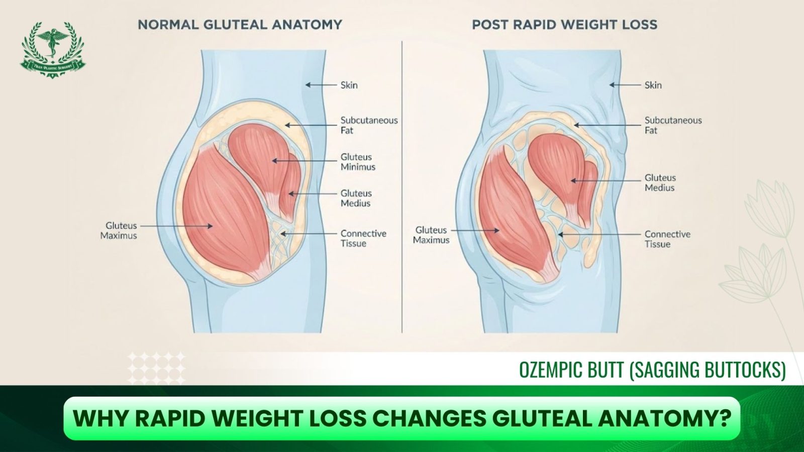 Why Rapid Weight Loss Changes Gluteal Anatomy?