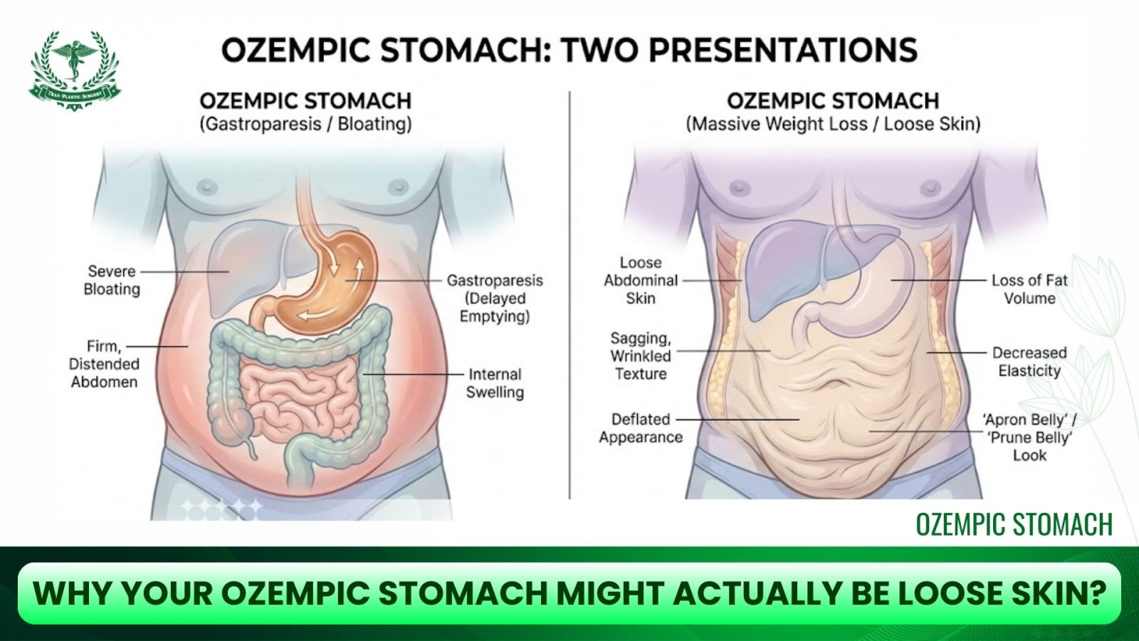 Why Your Ozempic Stomach Might Actually Be Loose Skin?