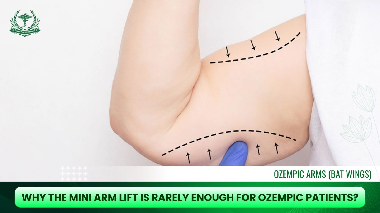 Why the Mini Arm Lift Is Rarely Enough for Ozempic Patients?