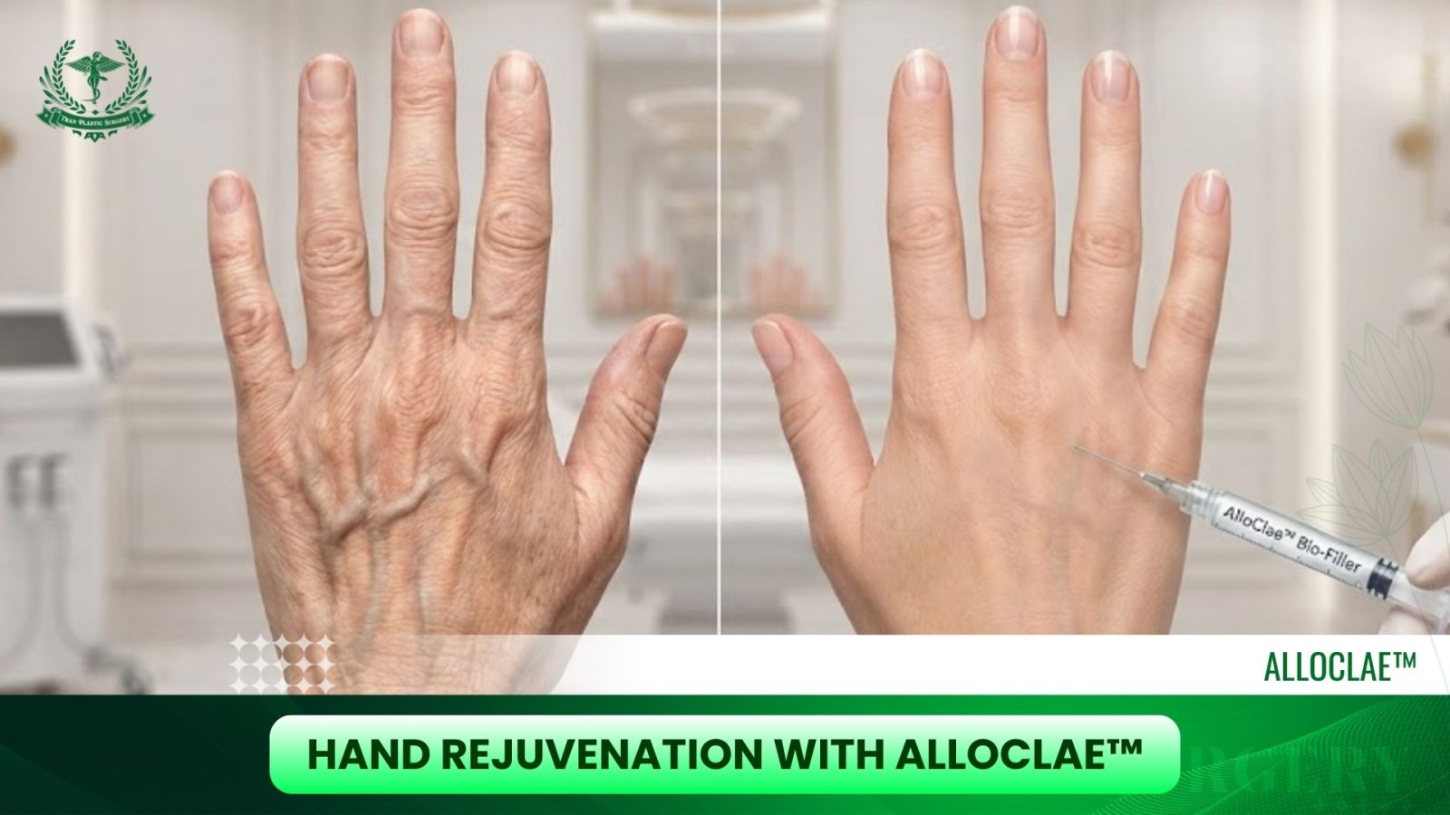 Hand Rejuvenation with AlloClae™