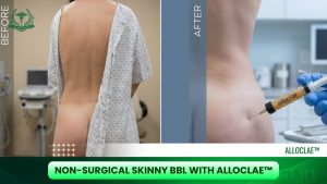 AlloClae Bio-Filler Treatment | Tranplastic Surgery