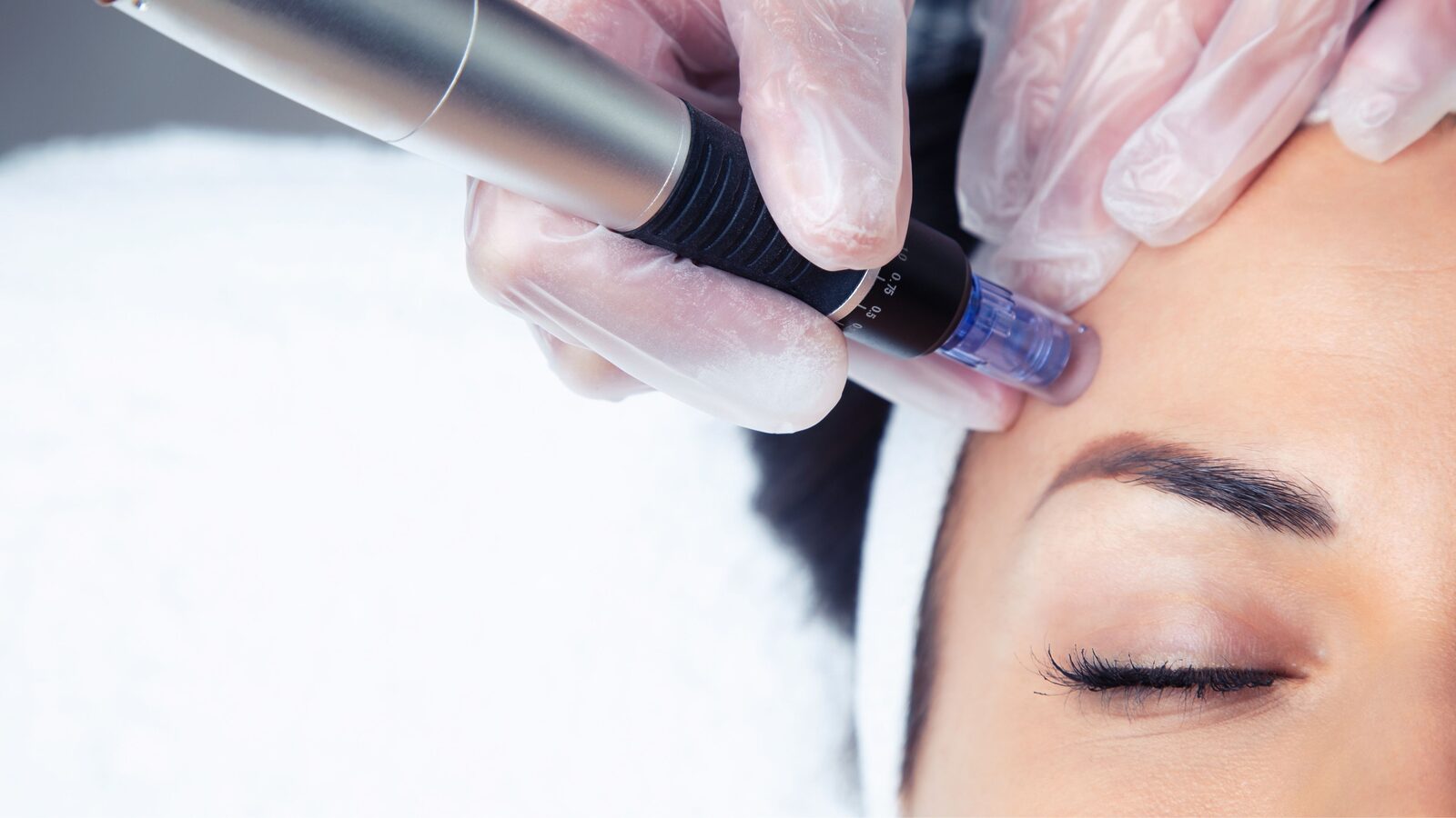 RF Microneedling Huntington Beach