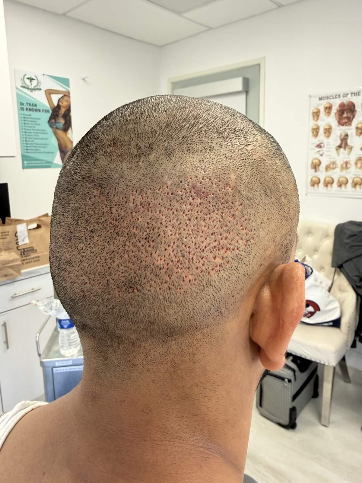 Donor area at the back of the scalp during an FUE hair transplant