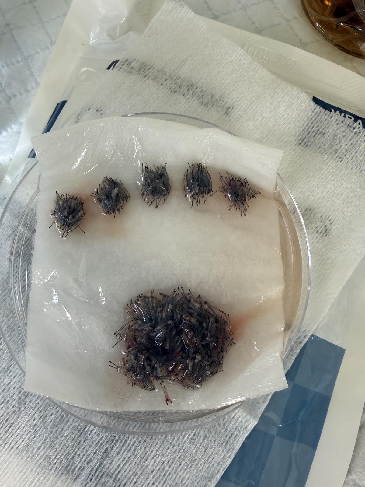 Extracted follicular unit grafts during an FUE hair transplant